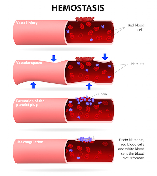 Figure 4: The process of hemostasis, or the stopping of blood flow in the body. When a blood vessel wall is injured, platelets stick to the damaged area and they become sticky with other platelets. The result is called a platelet plug, which stops the bleeding.