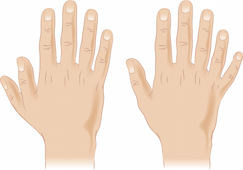 Figure 1:  People with Ellis-van Creveld Syndrome often have shorter forearms and lower legs, plus extra fingers and toes (polydactyly), malformed fingernails and toenails, and dental abnormalities.